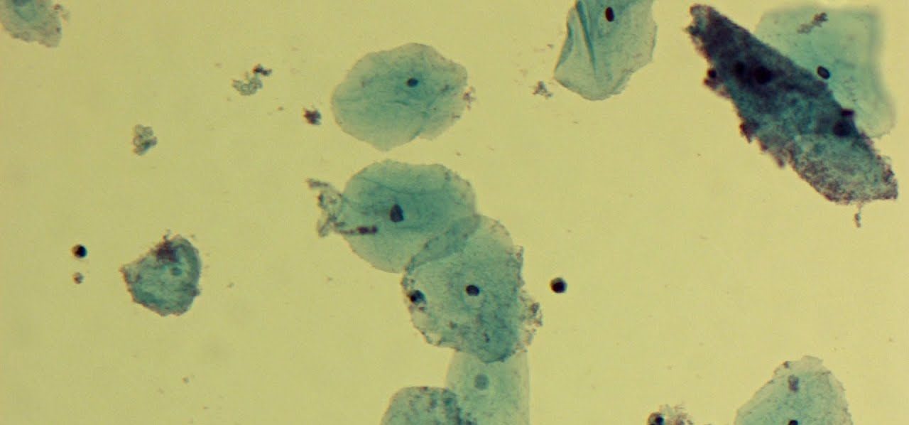 Гарднерелла и мобилункус. Гарднерелла откуда появляется. Gardnerella vaginalis полукачественный. Гарднерелла и мобилункус. Гарднереллез этиология.