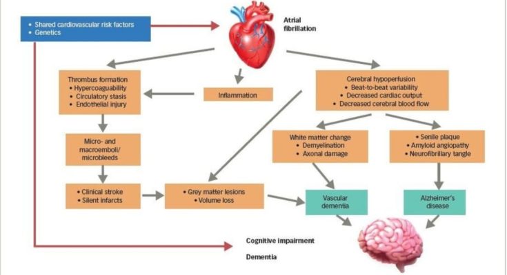 atrial fibrillation