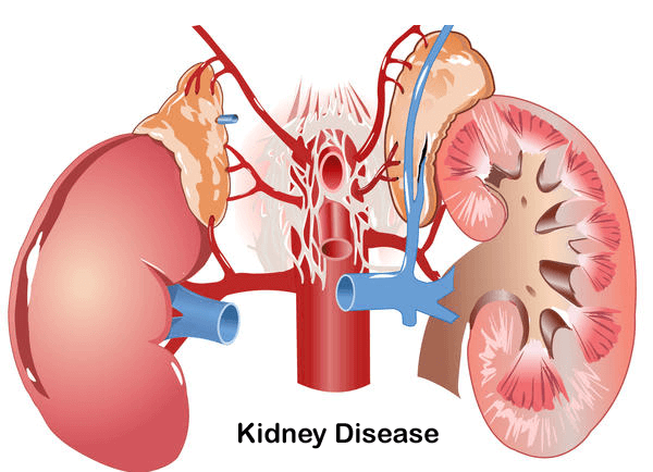 Signs and Causes of Kidney Failure